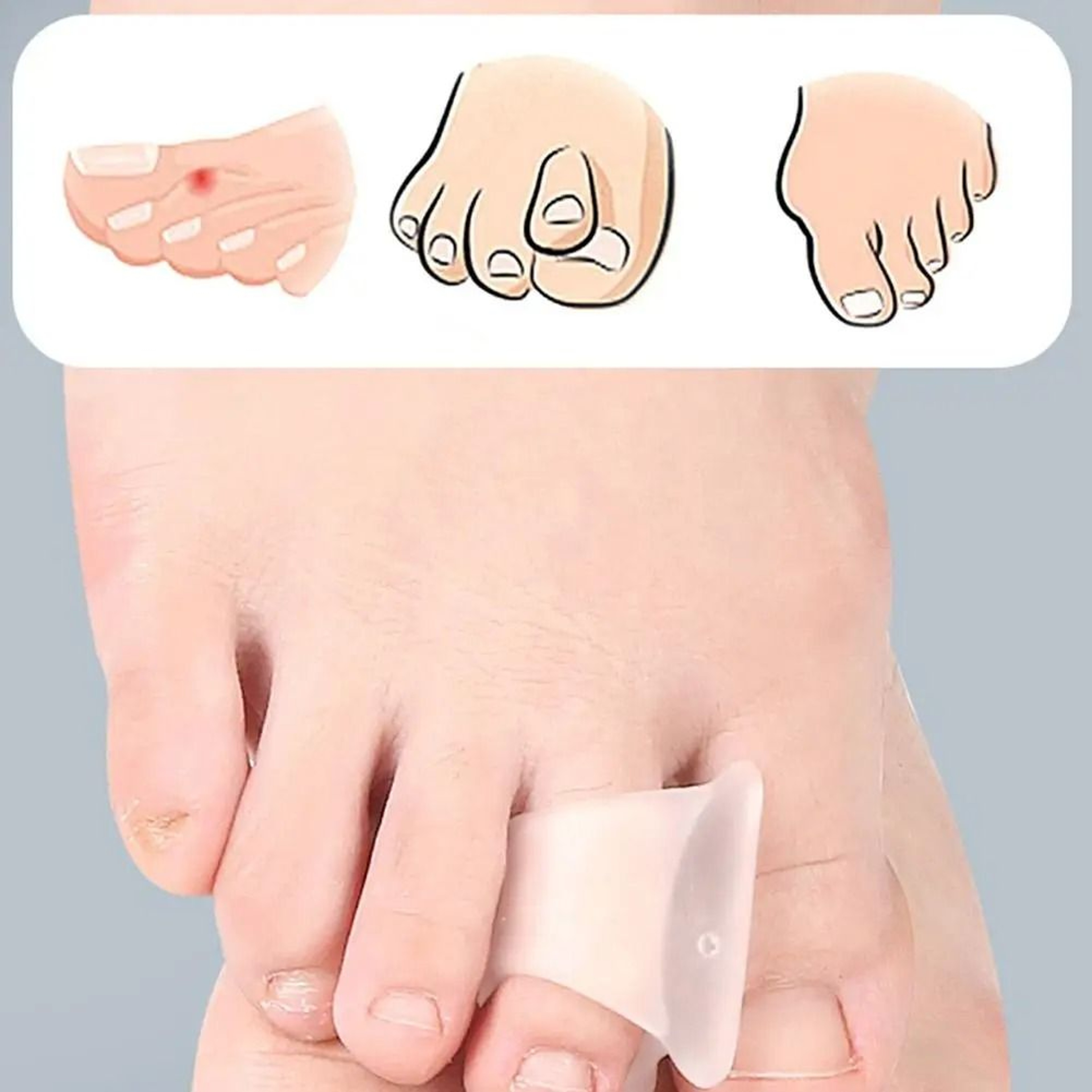 Toe Orthotics Hammertoe Corrector Set For Curled And Bent Toes Support 3