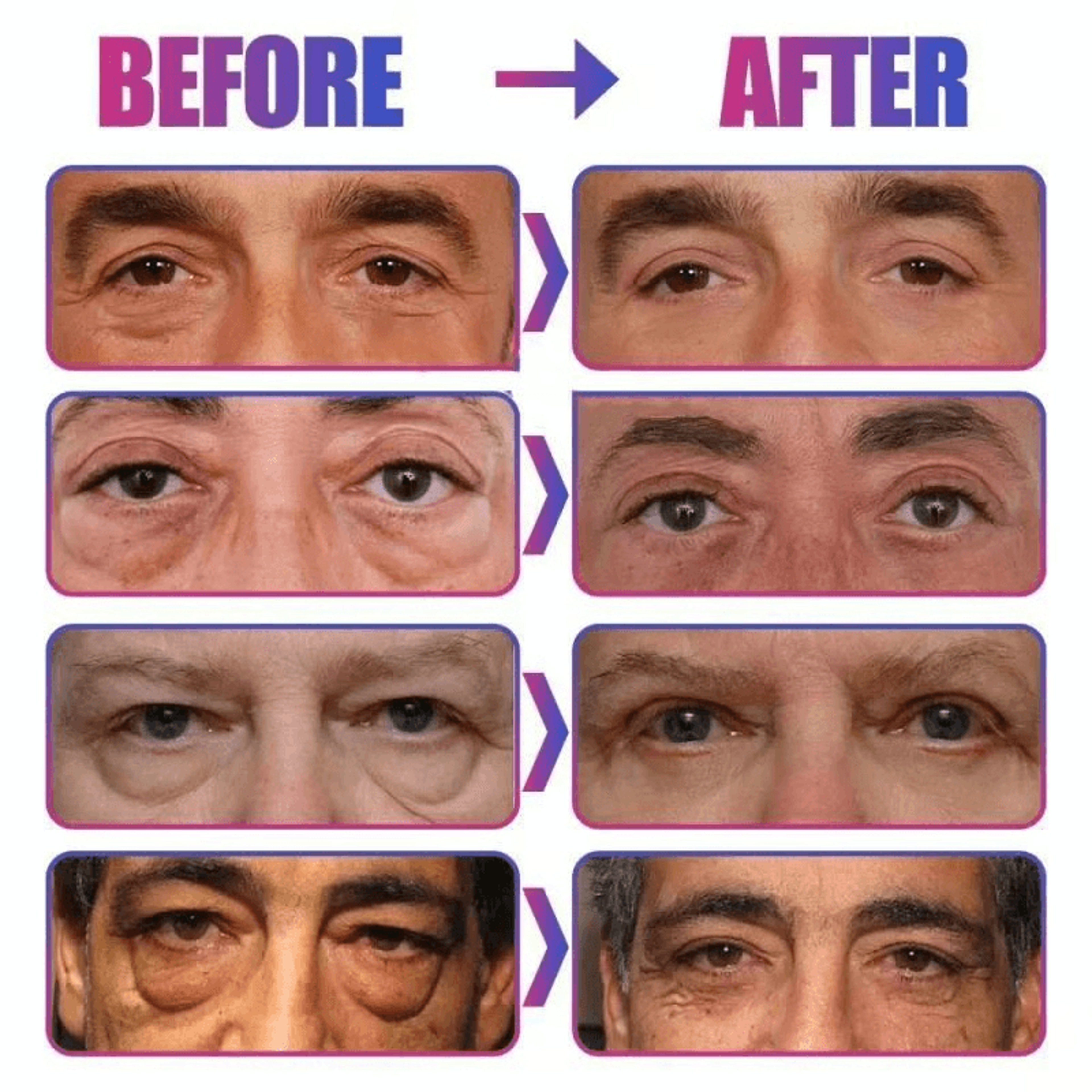 Cream for Puffy Eye Bags and Wrinkles