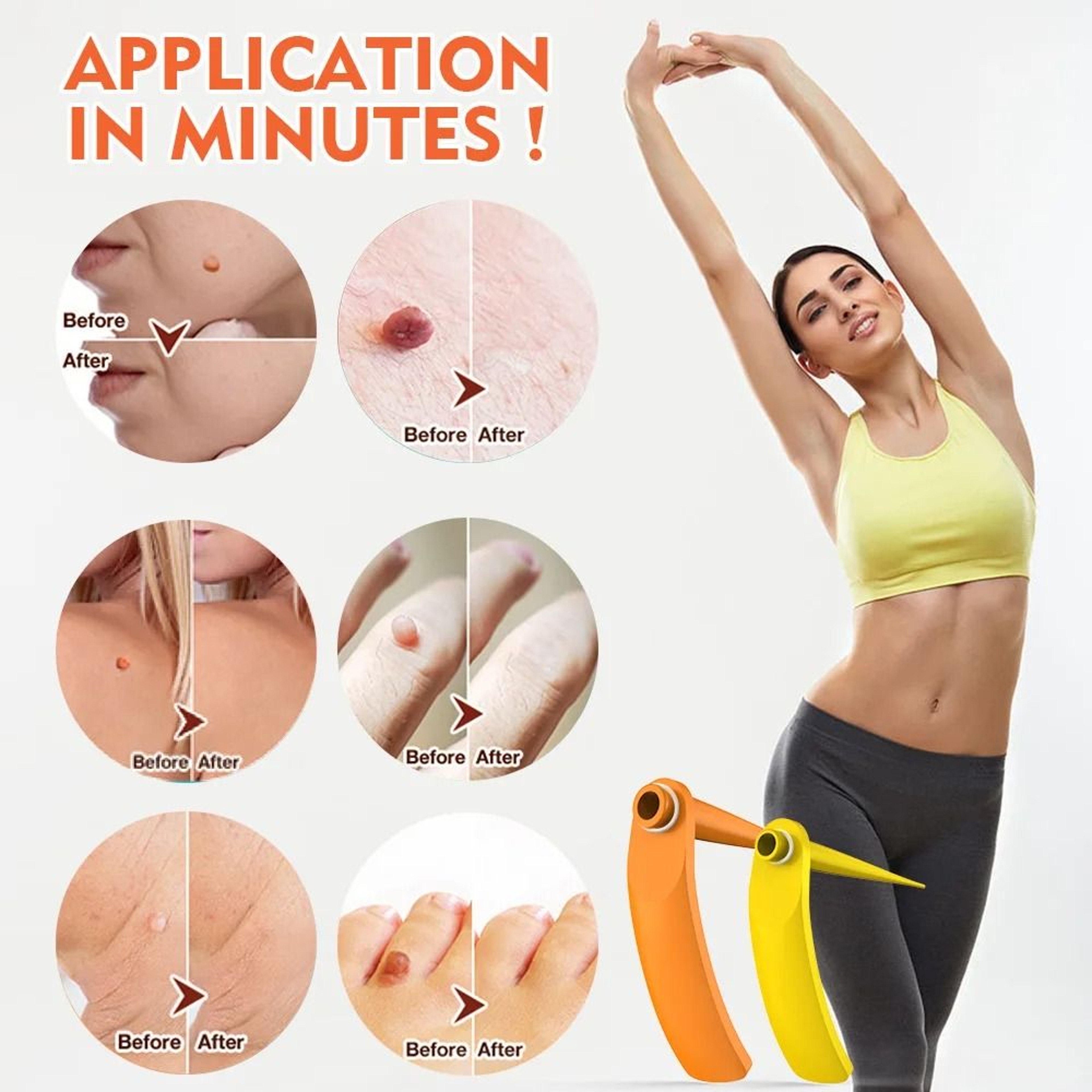2in1 Precision Skin Tag Removal System 1