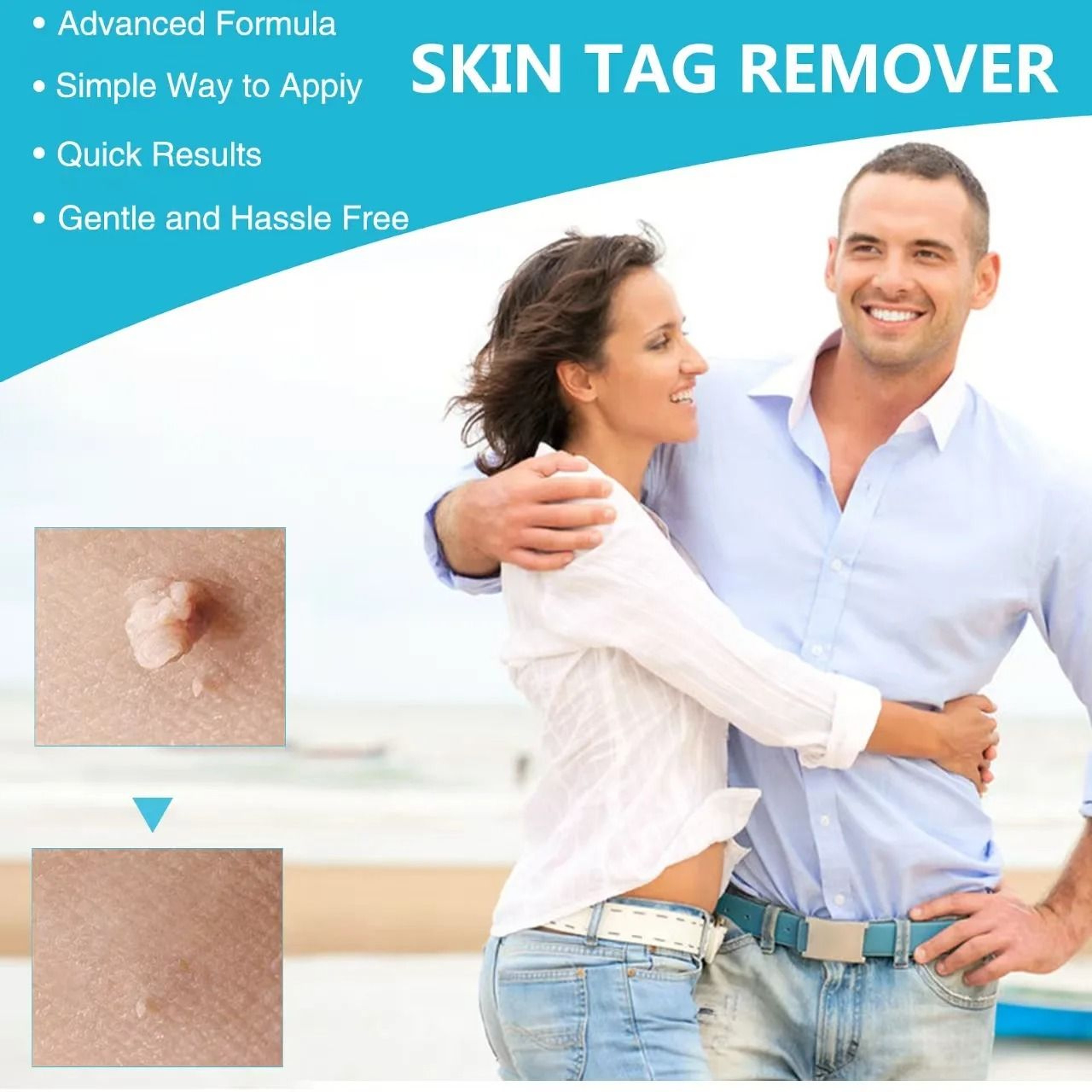 3 In 1 Portable Skin Tag Mole Wart Remover Tool Kit 3