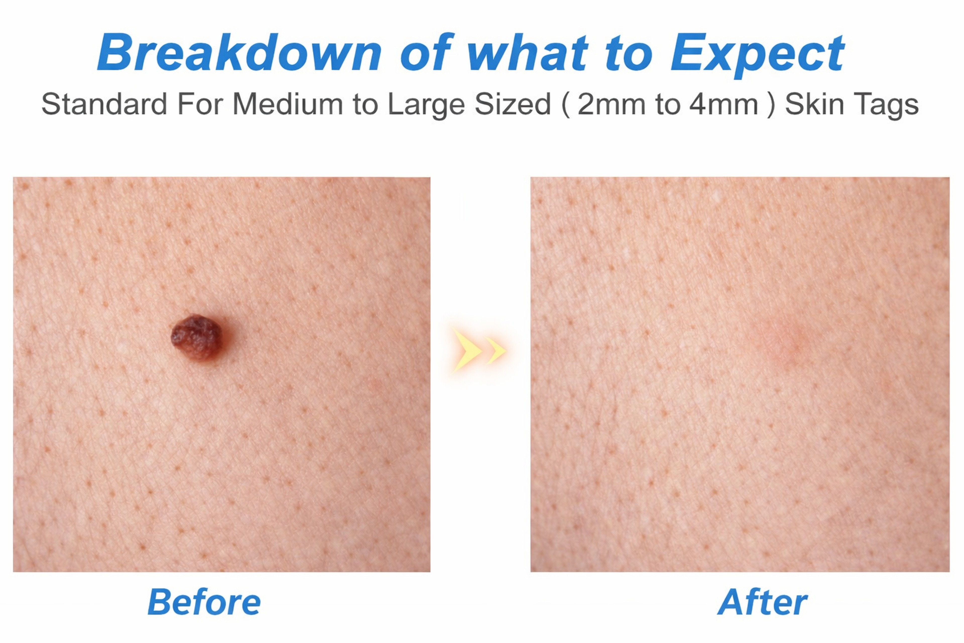 Painless Skin Tag Removal Kit for Safe At Home Skin Tag Treatment – view 10
