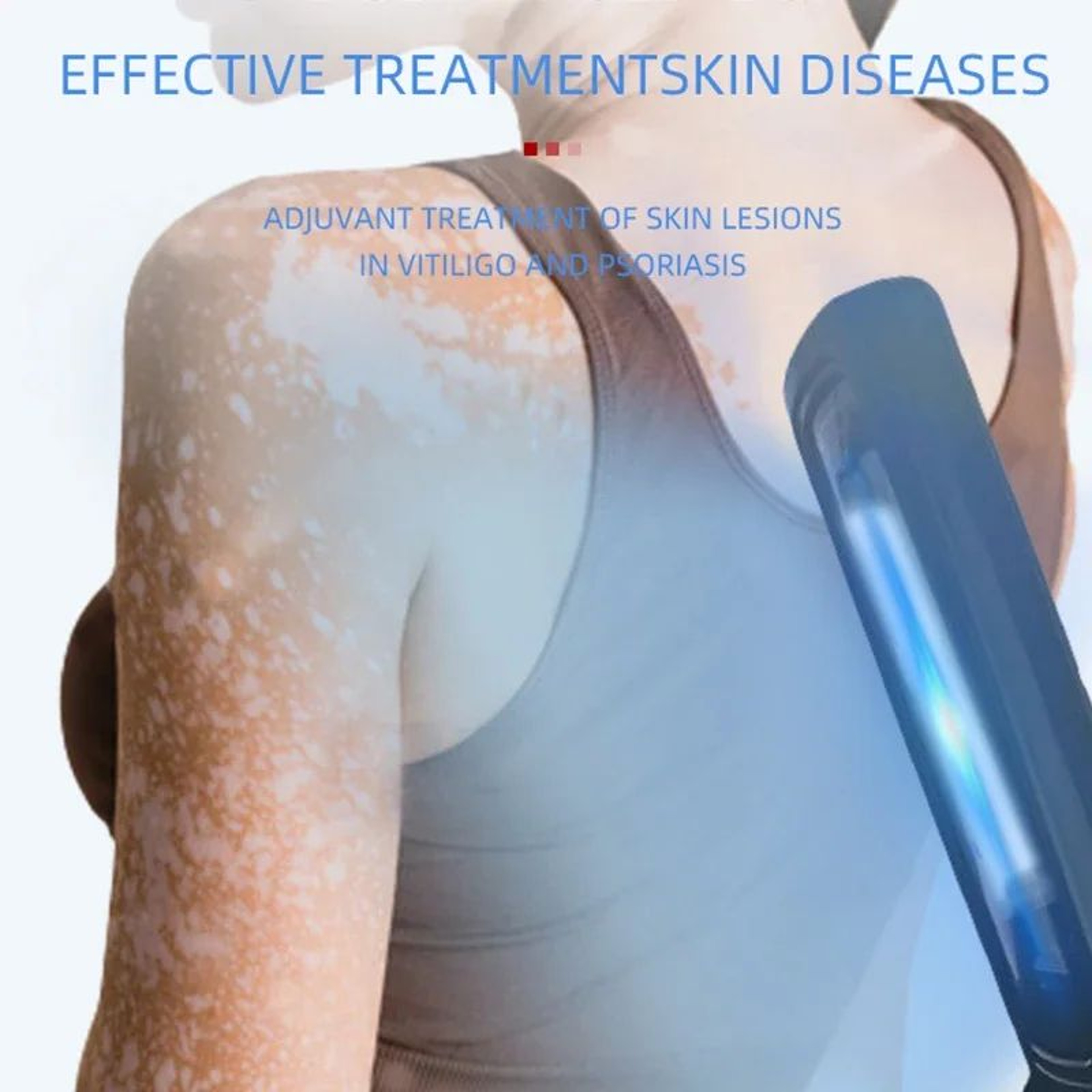 311NM Narrowband UVB Phototherapy Lamp  Portable Skin Therapy Light For Psoriasis Vitiligo  Eczema  0