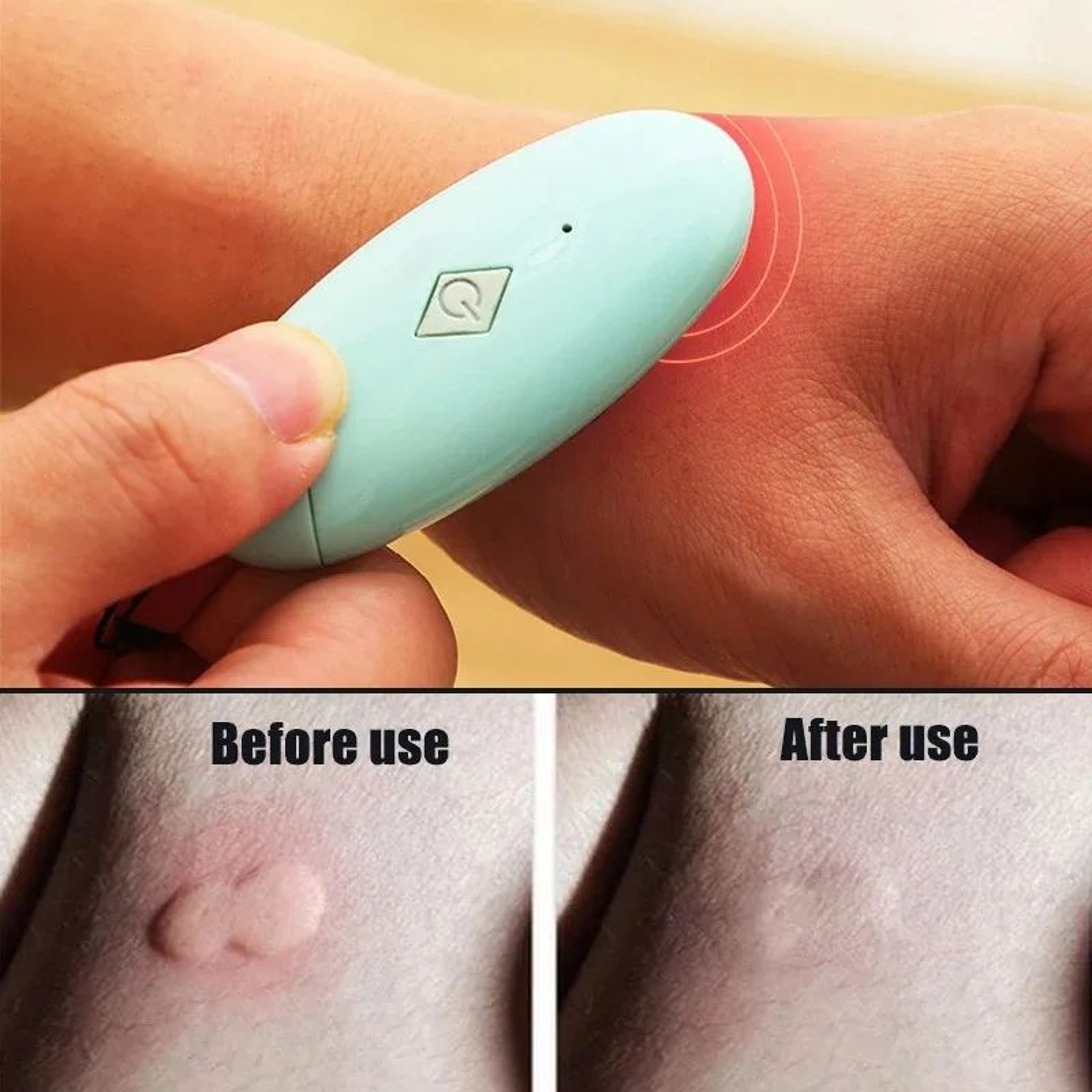 Chemical Free Insect Bite Relief Tool 0
