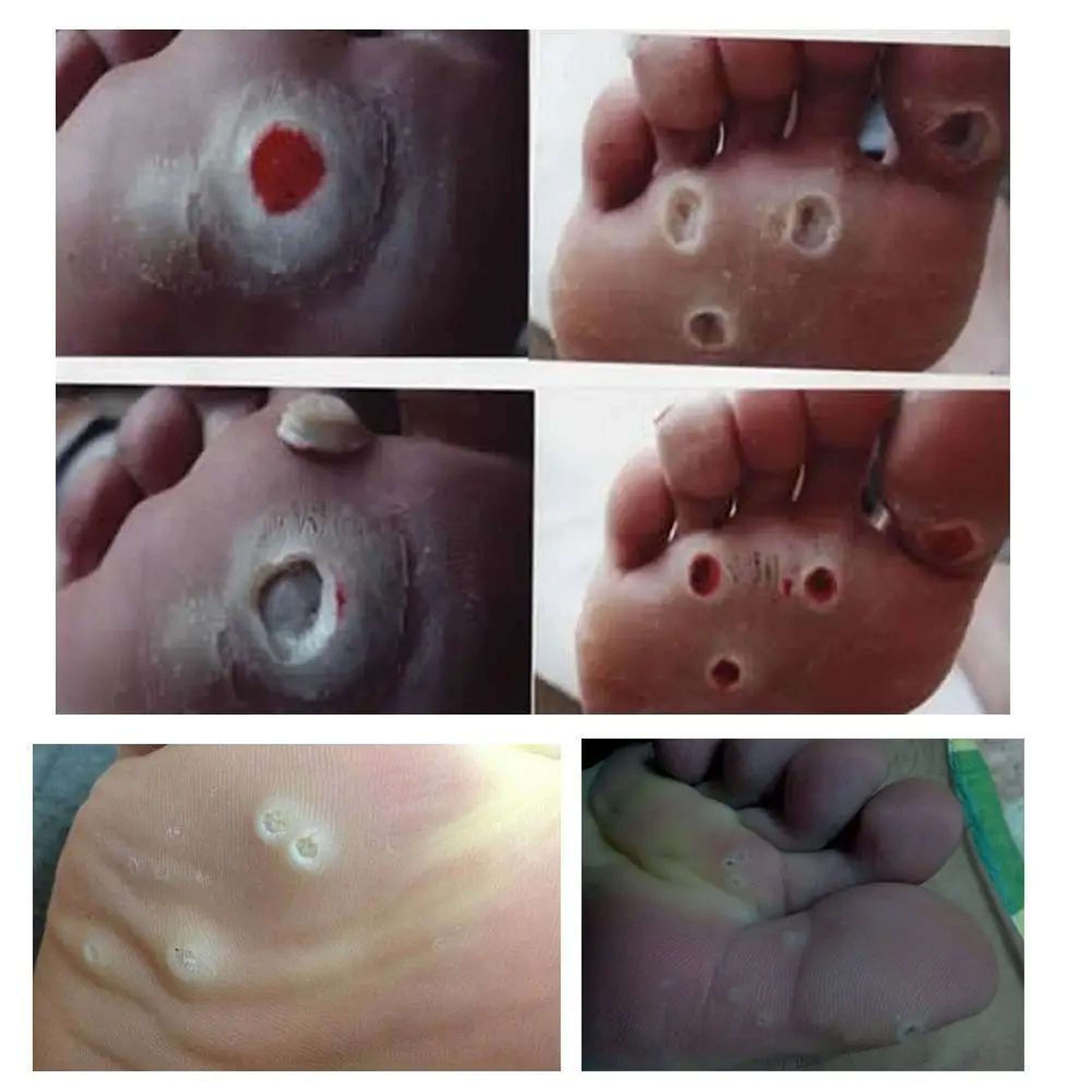 6 Pcs Foot Corn And Callus Protector Pads 7