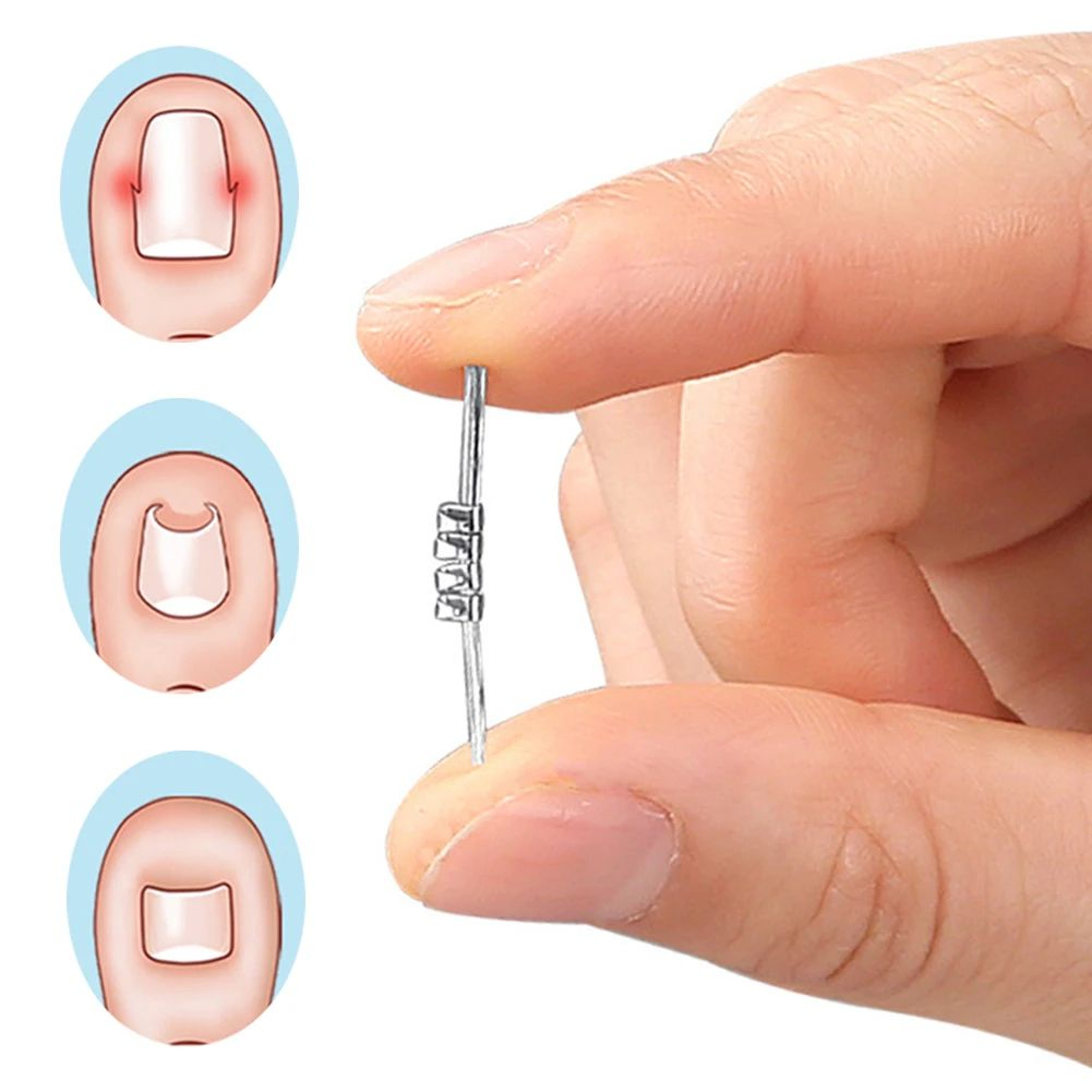 Ingrown Toenail Corrector Clamp Pedicure Tool 2
