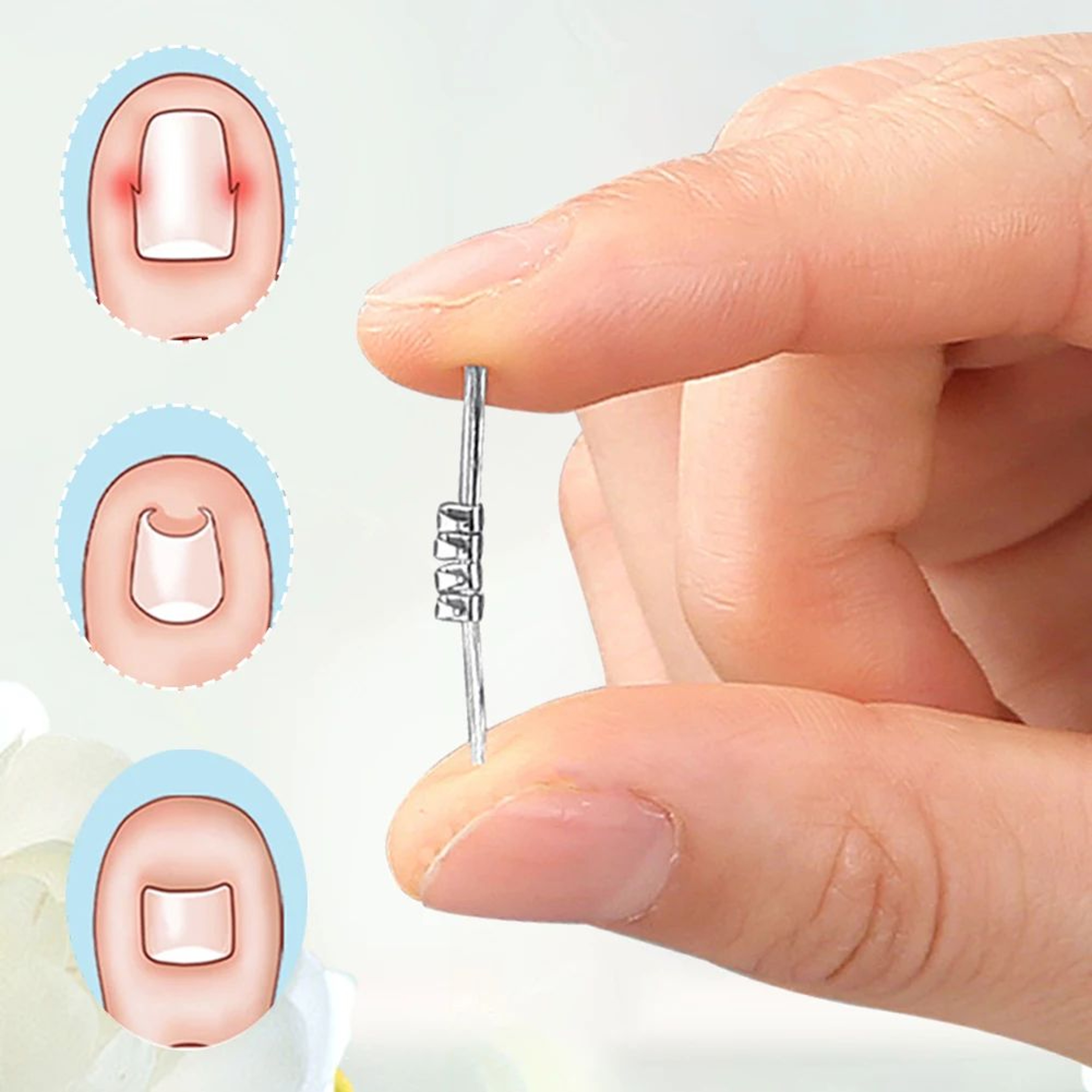 Ingrown Toenail Corrector Clamp Pedicure Tool 4