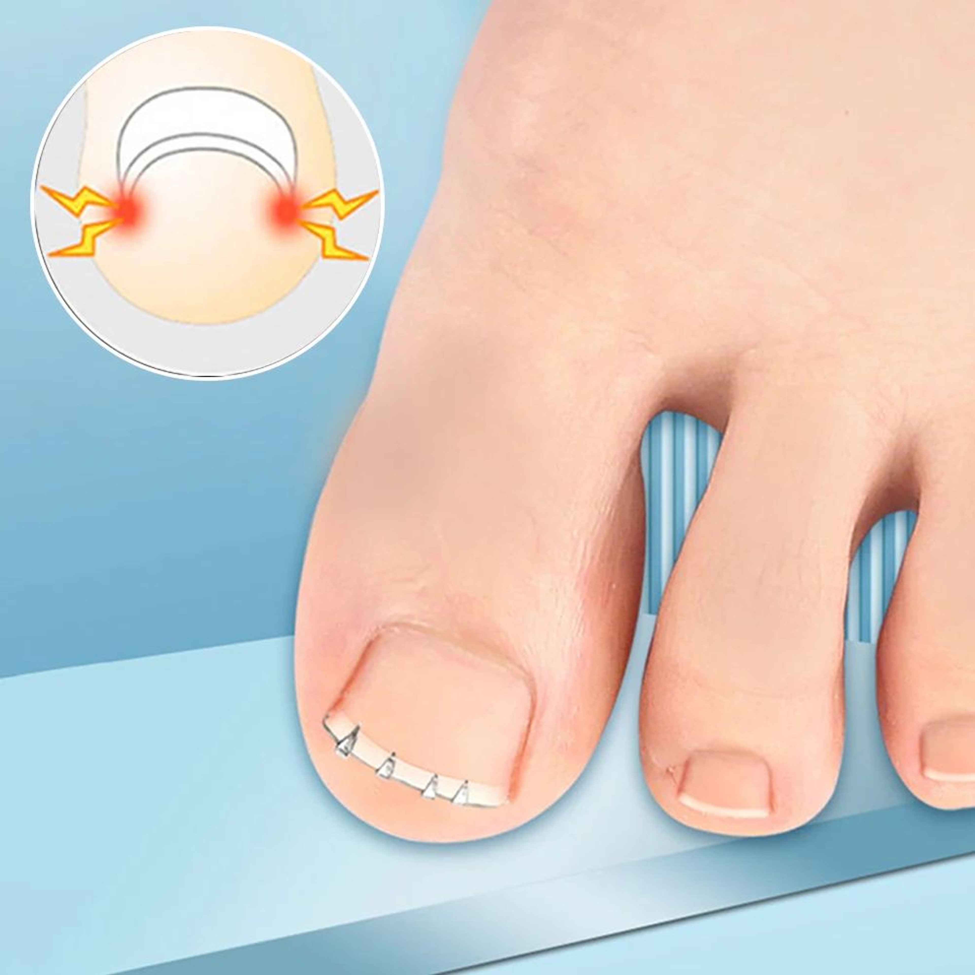 Ingrown Toenail Corrector Clamp Pedicure Tool 5