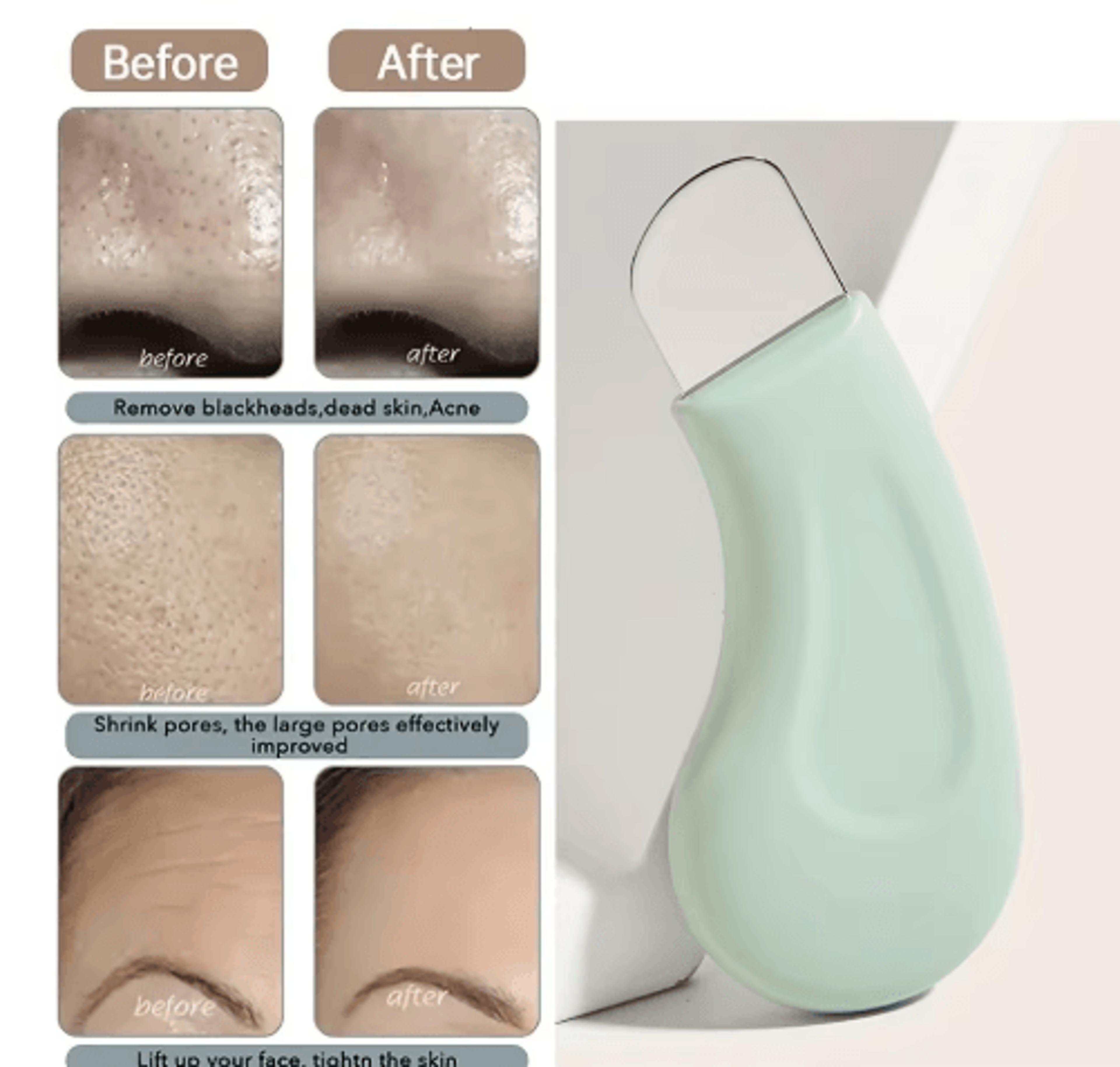 Stainless Steel Blackhead Removal Tool For Deep Pore Cleaning 0