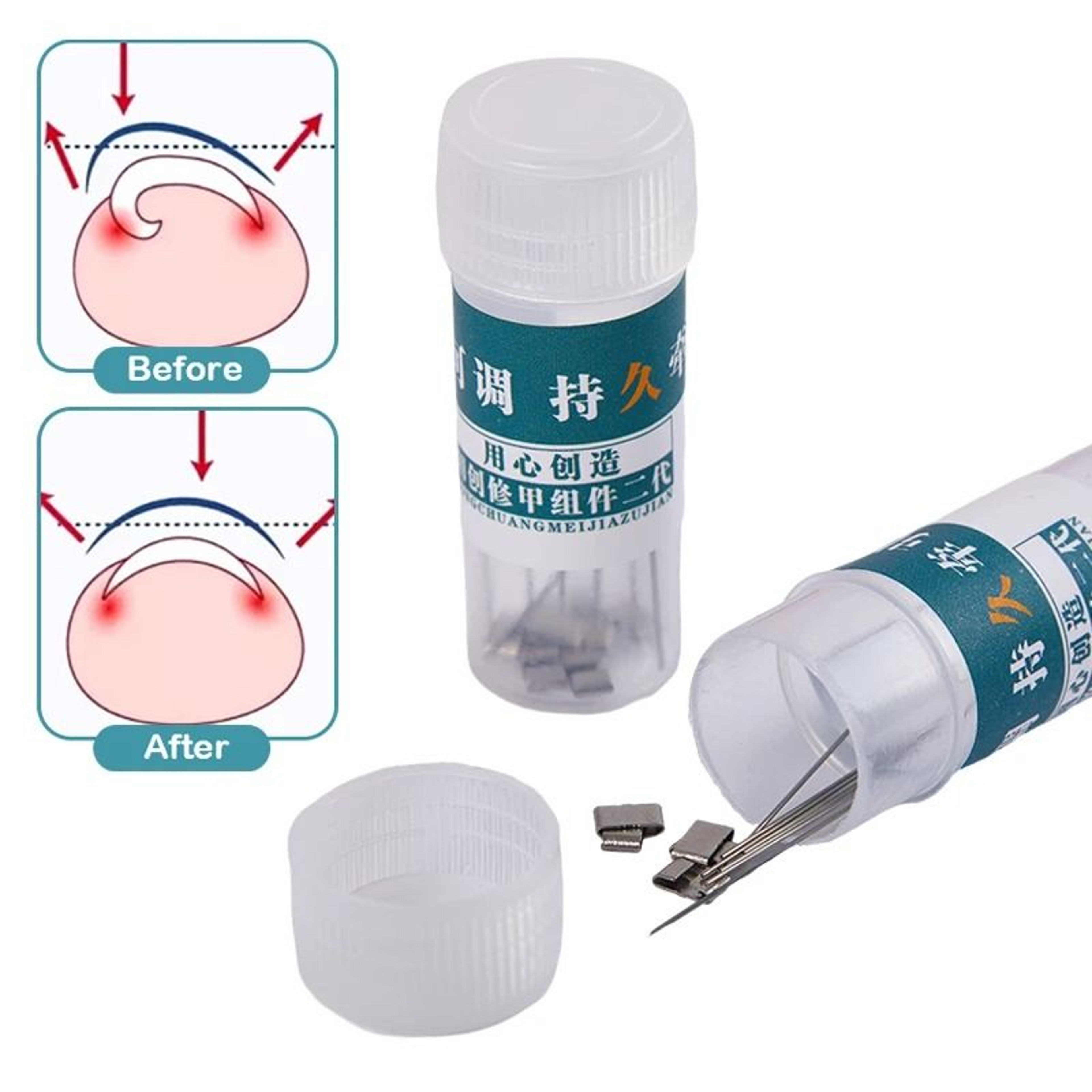 StraightEase Ingrown Toenail Corrector Professional Pedicure Tool 5
