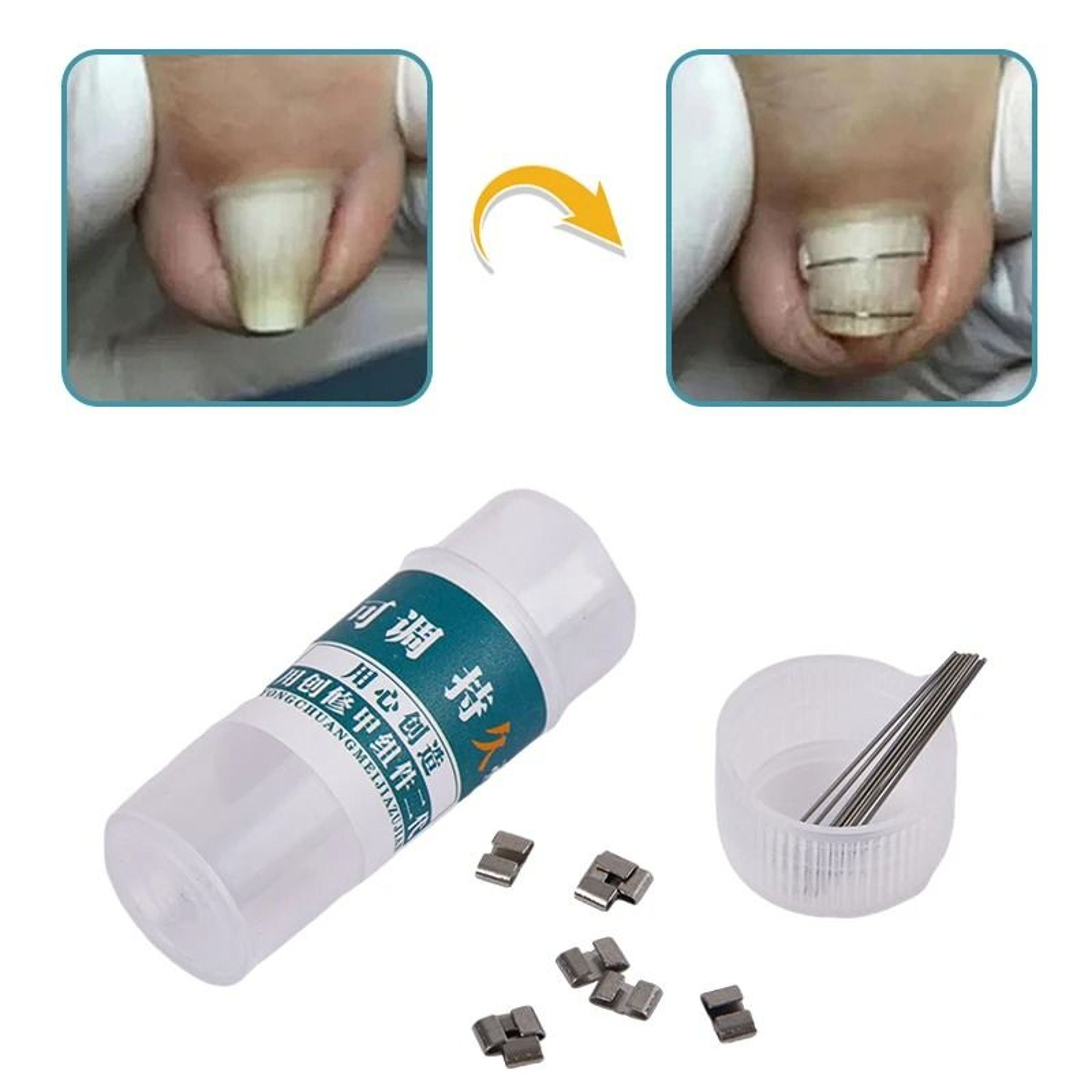 StraightEase Ingrown Toenail Corrector Professional Pedicure Tool 6