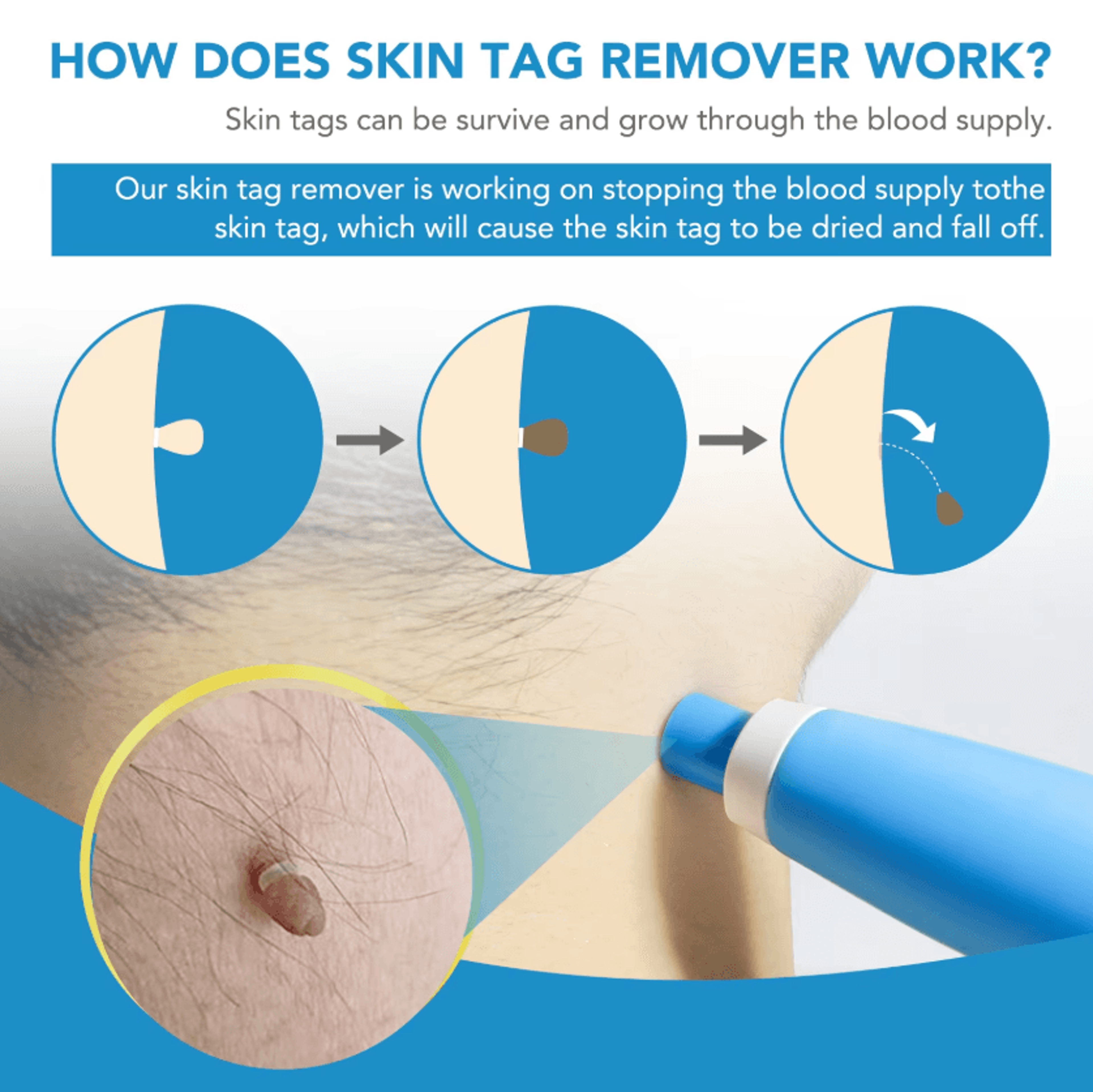 DermaClear Pro Skin Tag Remover Device 2in1 Micro Skin Tag Removal Tool Precision Beauty Care Kit 4