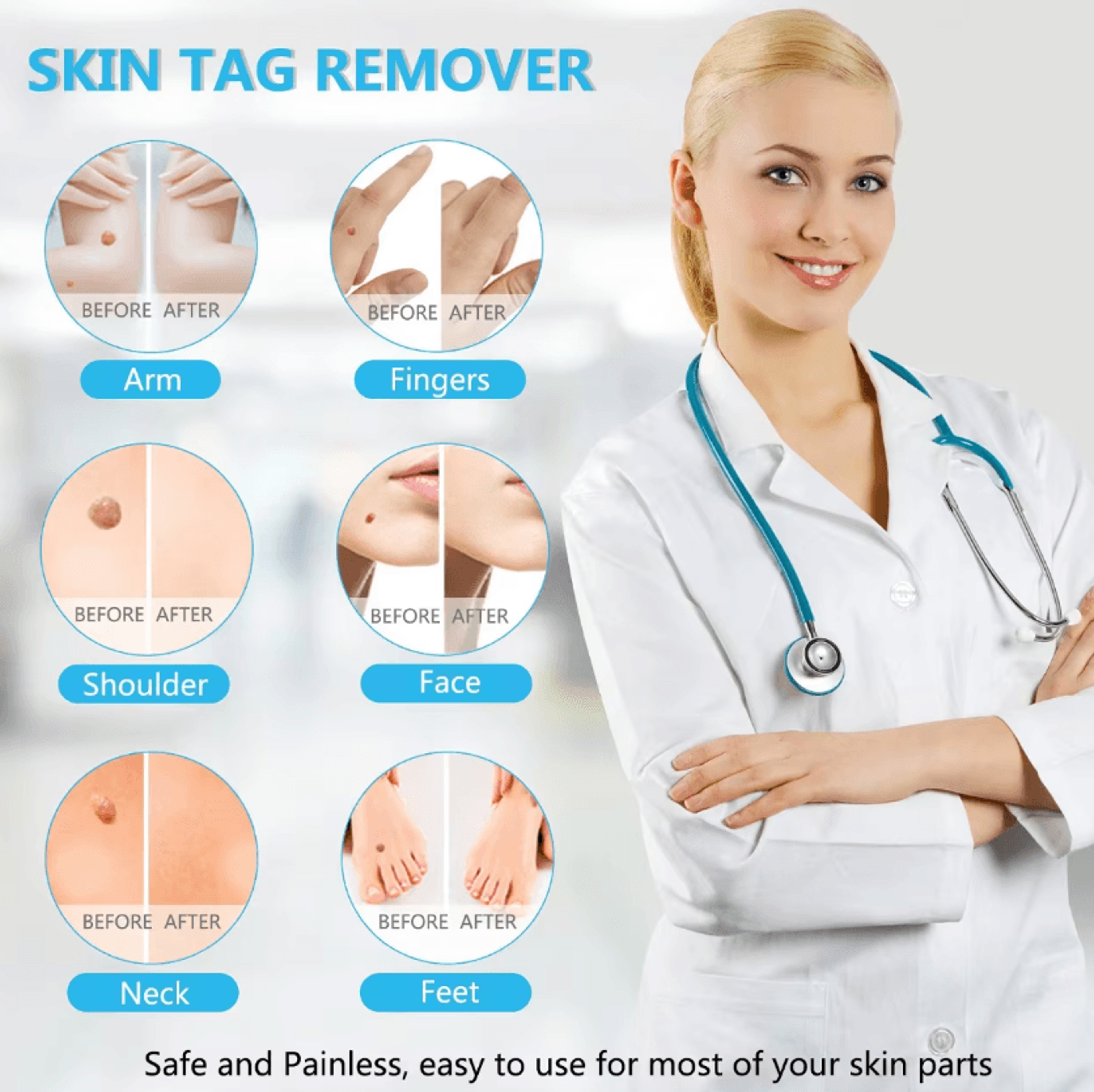 3in1 Auto Skin Tag Remover Kit  Painless Mole  Wart Removal Tool 1