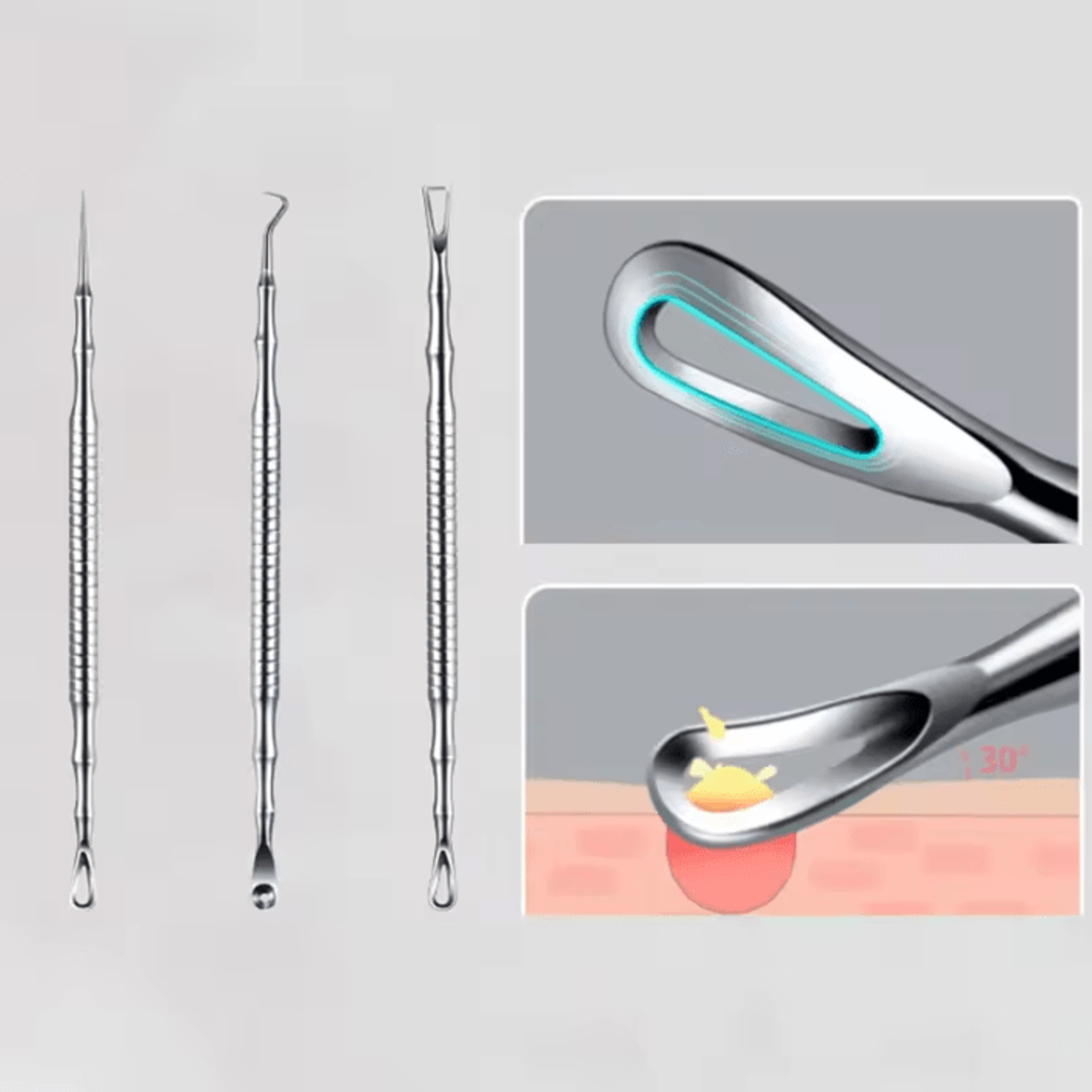 Professional Blackhead Remover Tool Kit With Milia Extractor And Blemish Removal Needles 0