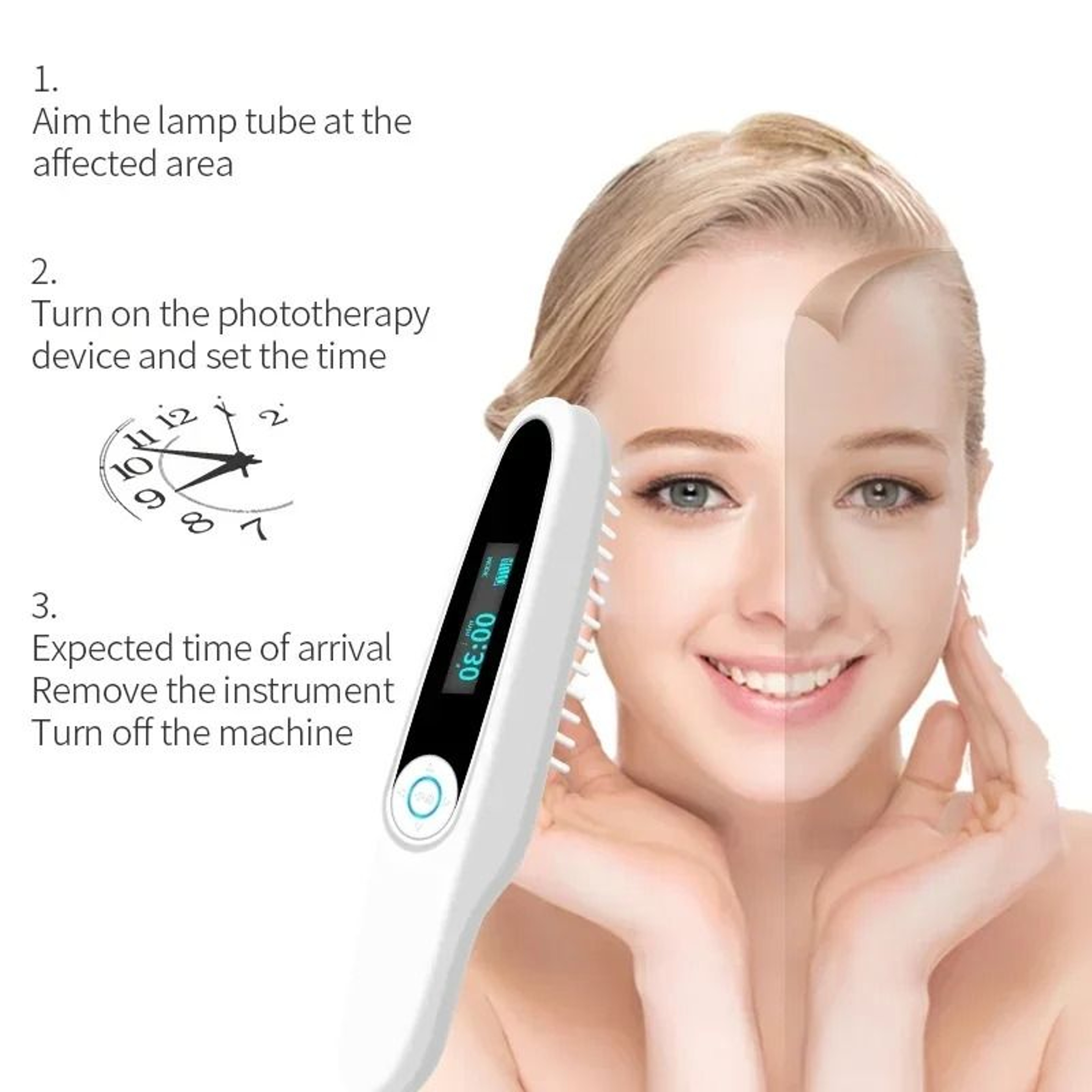 Handheld Narrowband UVB Phototherapy Instrument And 311nm Ultraviolet Skin Clearing Lamp 4