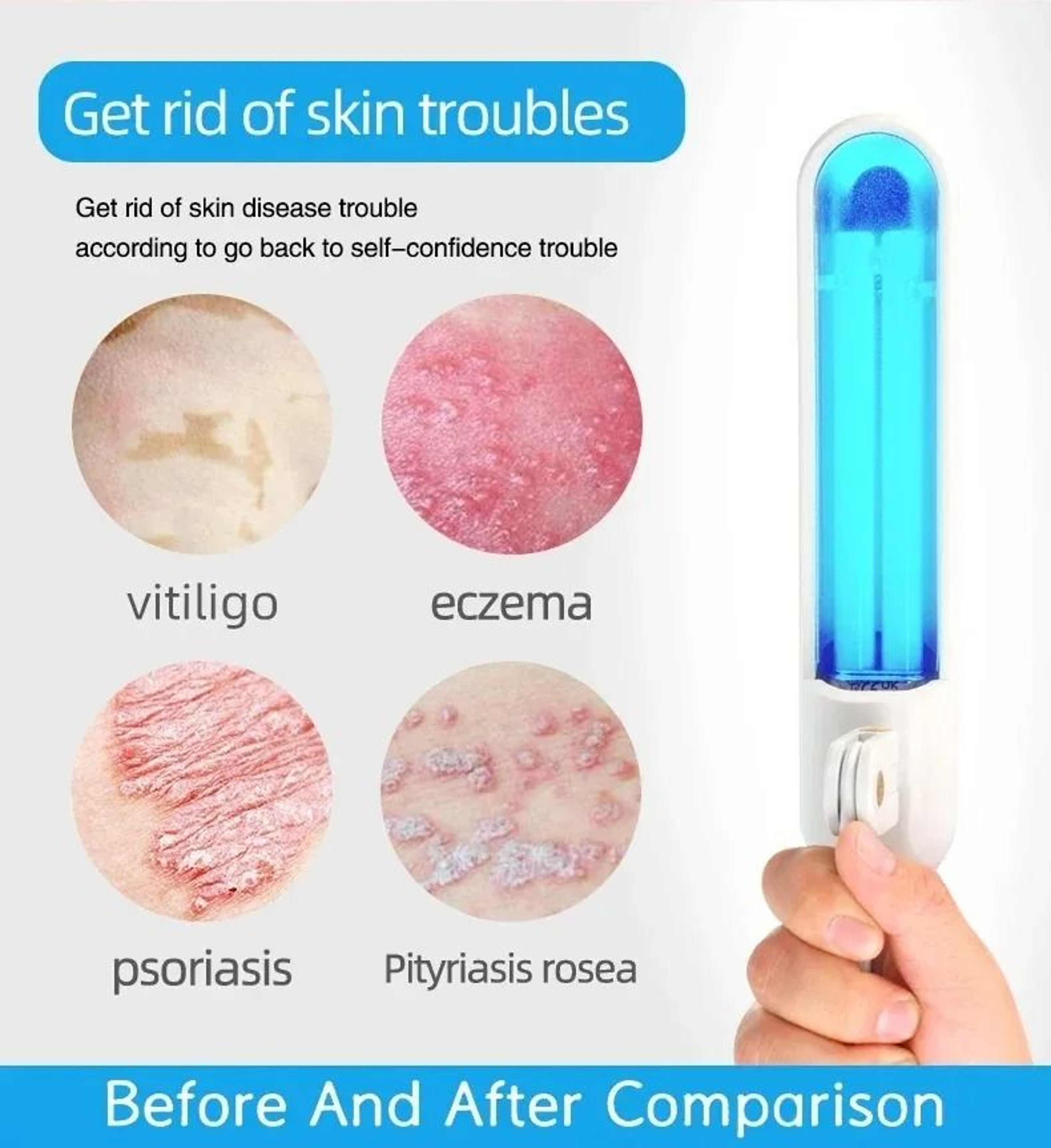 311nm Narrowband UVB Medical Grade Phototherapy Lamp For Skin Health Management 1