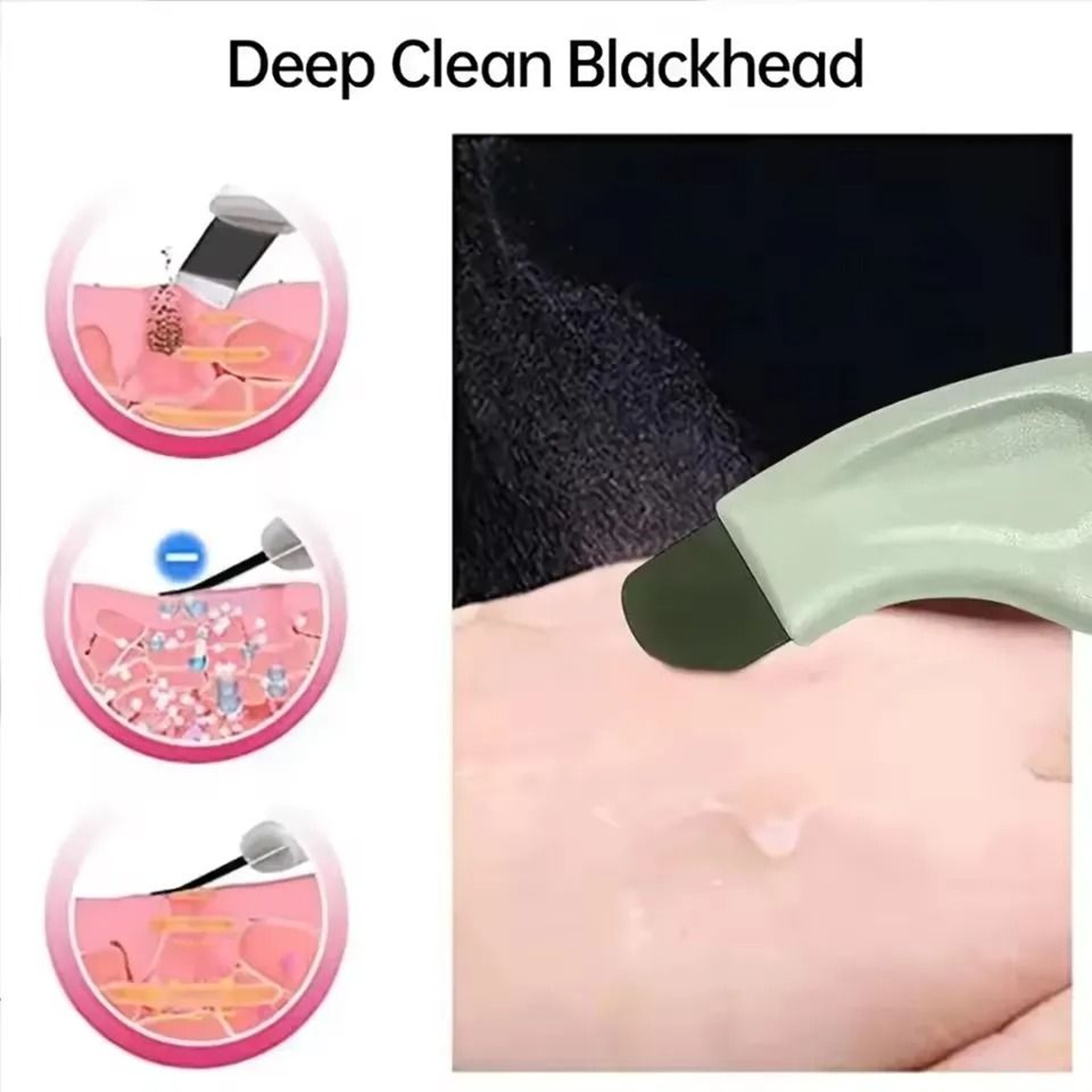 Deep Cleansing Blackhead And Whitehead Removal Tool 1