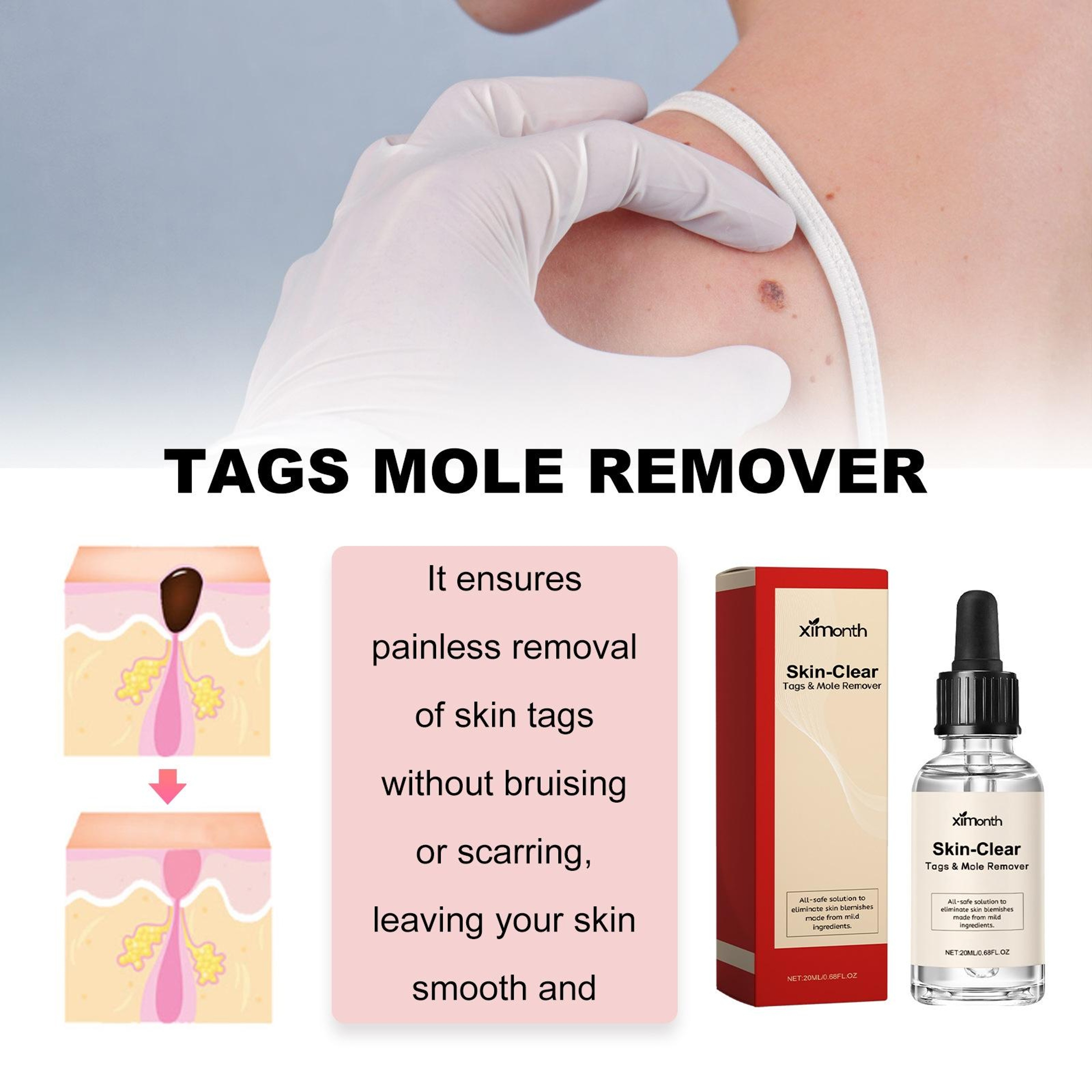 Ximonth Natural Wart Remover Liquid For Moles Skin Tags  Dark Spots 20ml 3