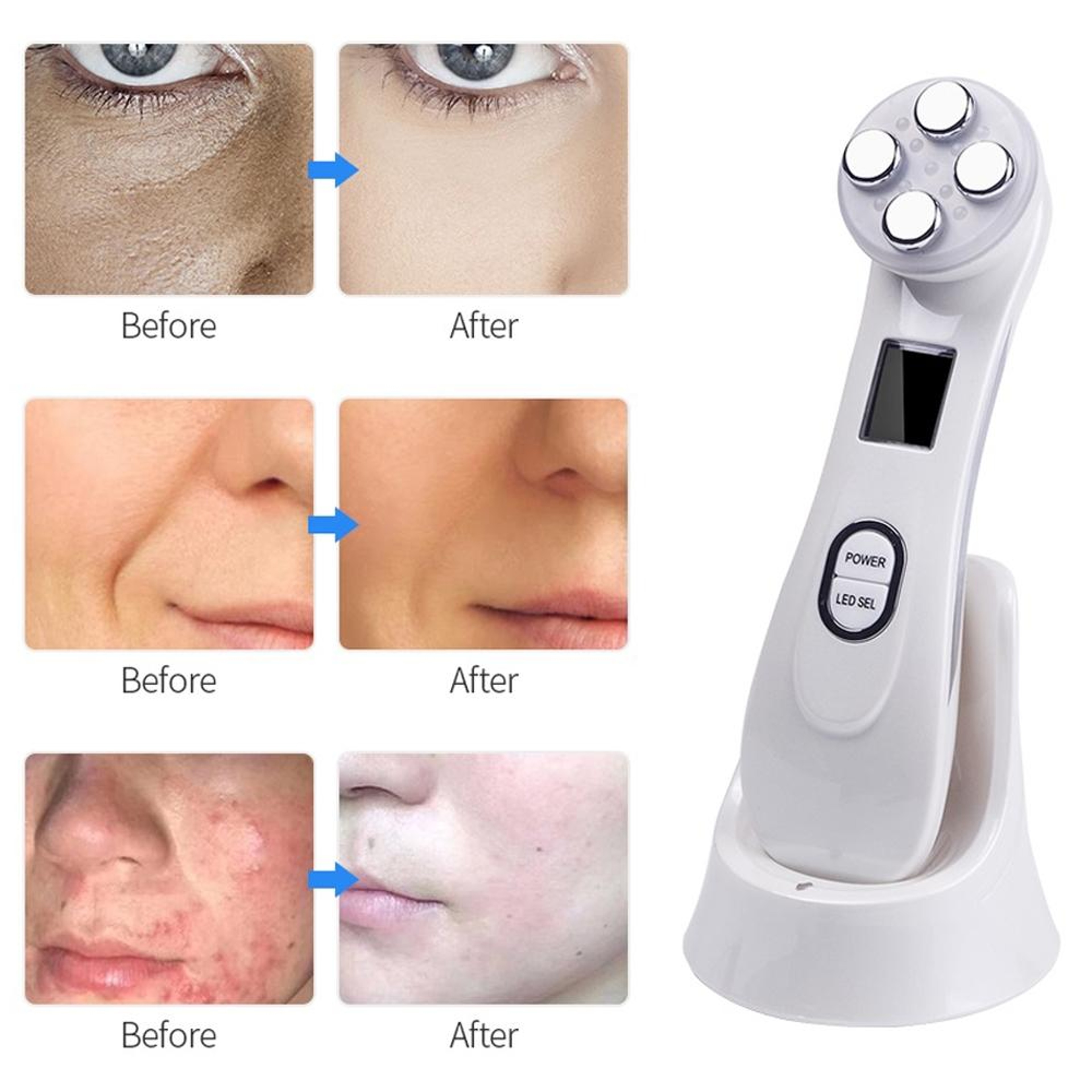 RF EMS Beauty Pen with LED Photon Therapy for Skin Tightening & Wrinkle Care – view 3